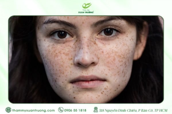 Tàn Nhang Bẩm Sinh Là Gì? Liệu Có Thể Điều Trị Dứt Điểm?