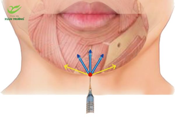 tiem filler cam 1 Mô phỏng kỹ thuật tiêm filler cằm giúp tạo dáng cằm cân đối tự nhiên