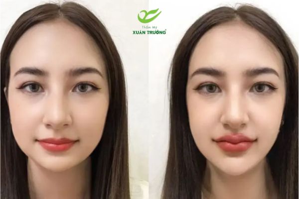 tiem filler cam 2 Khách hàng có cằm ngắn, lẹm được tư vấn dáng cằm phù hợp