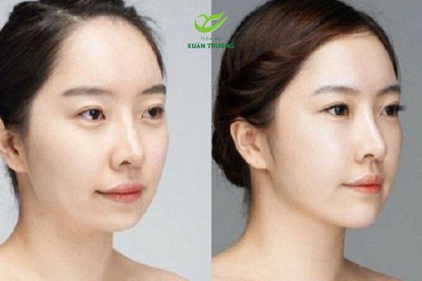 tiem filler cam 3 Tiêm filler cằm giúp gương mặt hài hòa, thon gọn và thanh thoát hơn