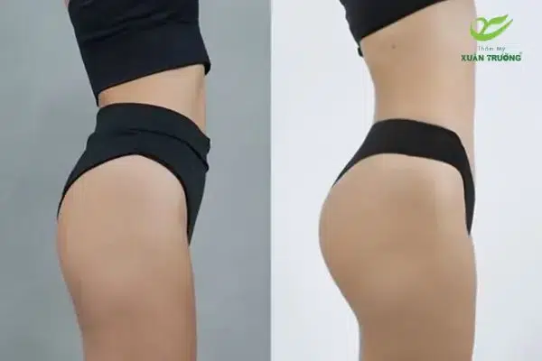 tiem filler mong 2 Khách hàng sở hữu vòng 3 căng tròn, săn chắc sau khi tiêm filler