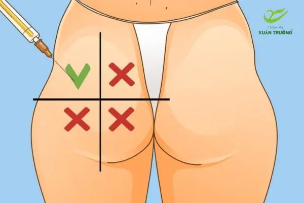 tiem filler mong 3 Cảnh báo biến chứng nếu tiêm filler mông sai kỹ thuật