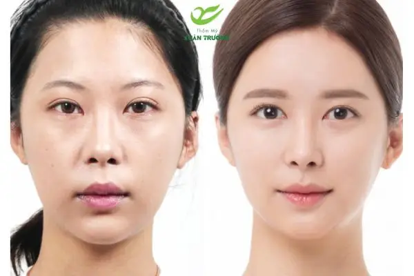 tiem filler ranh cuoi 1 Kết quả làm đầy rãnh cười rõ rệt, khuôn mặt trẻ trung hơn