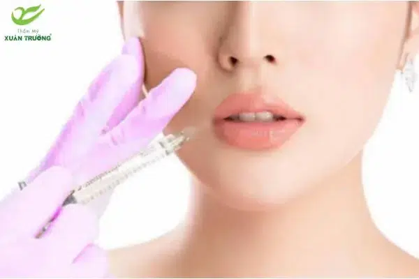 tiem filler ranh cuoi 2 Chăm sóc đúng cách giúp duy trì hiệu quả filler lâu dài hơn