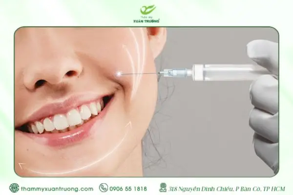 Tiêm Filler Rãnh Cười Là Gì? Có Nên Thực Hiện Không?