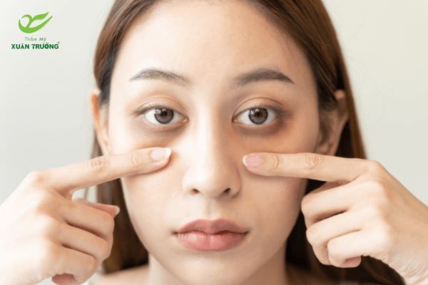 xoa quang tham mat 1 Những yếu tố quyết định chi phí điều trị quầng thâm mắt