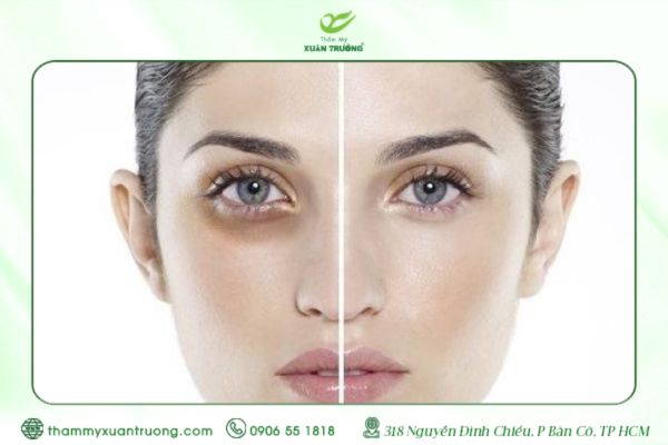 Xóa Quầng Thâm Mắt Vĩnh Viễn Giá Bao Nhiêu? Cập Nhật 2025