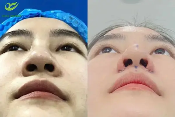 Cấu trúc cánh mũi trước và sau chỉnh hình