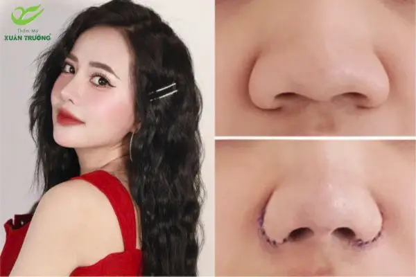 Trường hợp cánh mũi to bè phù hợp thu gọn cánh