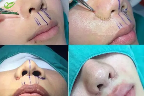 Bác sĩ tiến hành tạo hình cánh mũi an toàn, tỉ mỉ