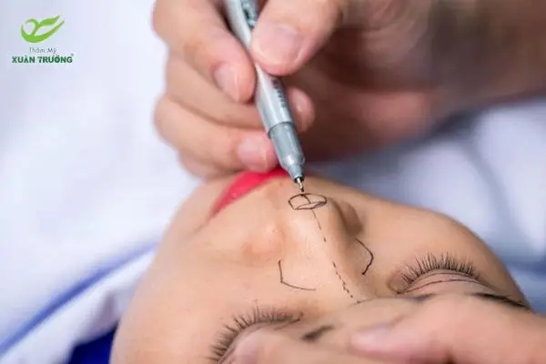 Bác sĩ đo vẽ dáng mũi, thực hiện quy trình chuẩn y khoa