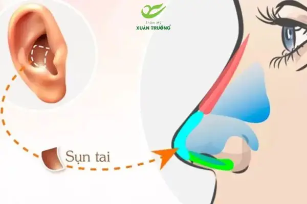 Sử dụng sụn cơ thể mang lại dáng mũi tự nhiên