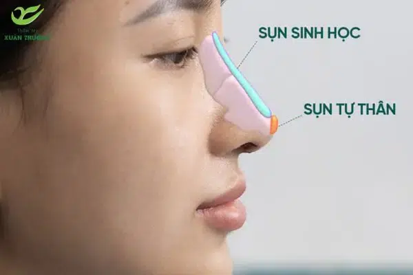 Sụn nhân tạo giúp dáng mũi cao, sắc nét