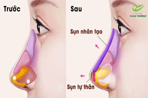 Mô phỏng cấu trúc sụn nhân tạo trong nâng mũi
