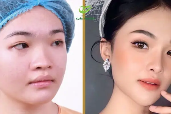 Nâng mũi sụn nhân tạo hiệu quả rõ nét và thời gian hồi phục nhanh