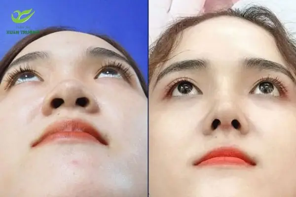 Dáng mũi nhỏ gọn, tự nhiên sau khi thu nhỏ đầu mũi