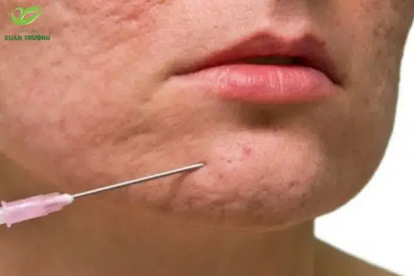 Tiêm collagen trị sẹo lõm nhanh chóng, hiệu quả