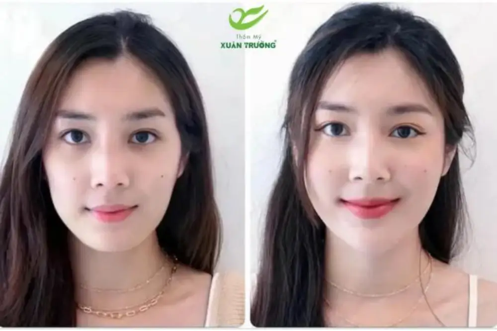 Kết quả tiêm má baby duy trì lâu dài