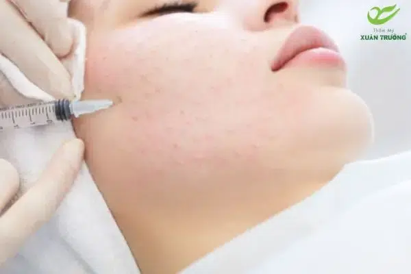 Tiêm Meso trị sẹo rỗ cải thiện làn da mịn màng hơn