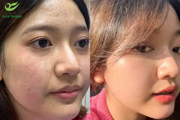 Kết quả rõ rệt chỉ sau vài lần tiêm Meso trị sẹo rỗ