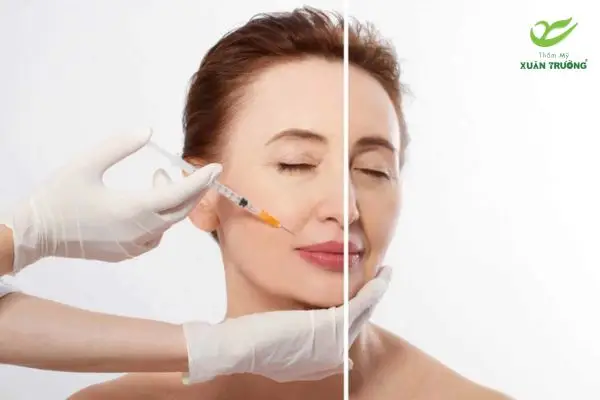 Tiêm tan filler giúp khắc phục filler lệch
