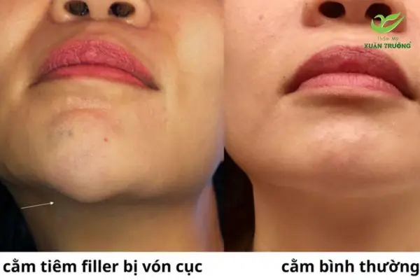 Trường hợp filler bị vón, lệch hoặc không đều sau tiêm
