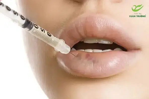 Kỹ thuật tiêm tan filler được thực hiện đúng chuẩn y khoa an toàn