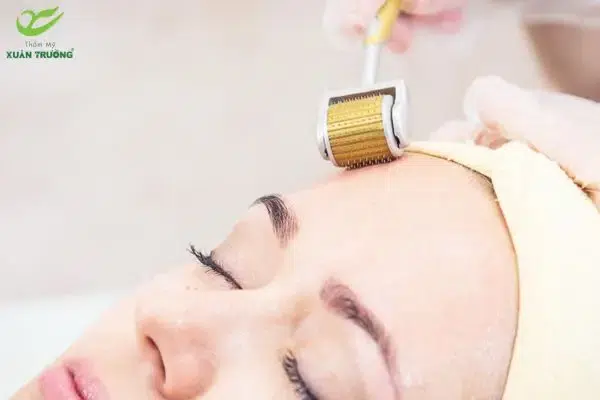 Lăn kim kết hợp tế bào gốc giúp tăng tái tạo bề mặt da
