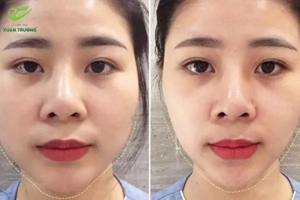 tiem botox gon ham kieng gi 1 Tiêm botox gọn hàm kiêng gì để được ổn định và an toàn