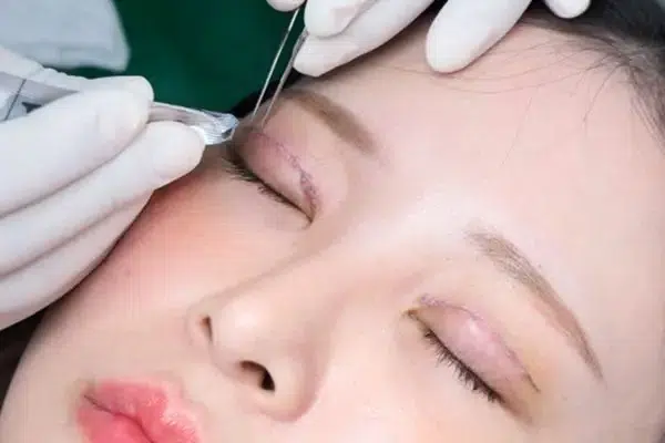 Vùng mí mắt sau cắt cần được bảo vệ và chăm sóc đúng cách