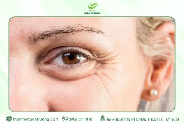 Nếp Nhăn Dưới Mắt: Nguyên Nhân Và Giải Pháp Cải Thiện