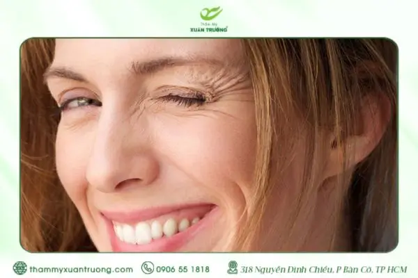 Nếp Nhăn Quanh Mắt Khi Cười – Nguyên Nhân Và Cách Khắc Phục