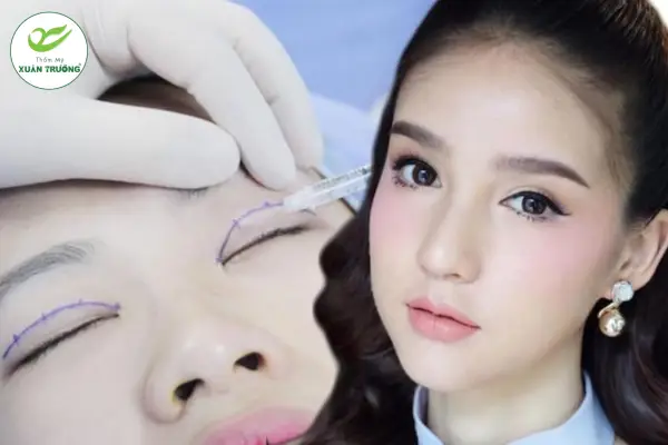 nhan mi bao nhieu tien 1 Nhấn mí giúp tạo nếp mí rõ nét, tự nhiên không cần phẫu thuật