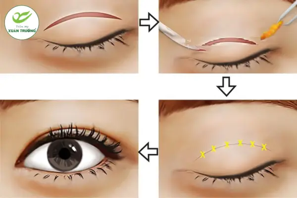nhan mi bao nhieu tien 2 Nhấn mí bao nhiêu tiền phụ thuộc nhiều yếu tố về kỹ thuật và chuyên môn
