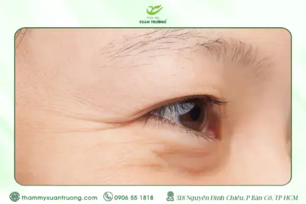 Bí Quyết Xóa Nếp Nhăn Đuôi Mắt Chị Em Nên Biết Sớm