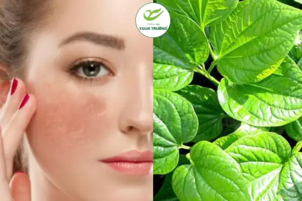 cach tri nam bang la lot 3 Lưu ý quan trọng khi áp dụng lá lốt trị nám tại nhà