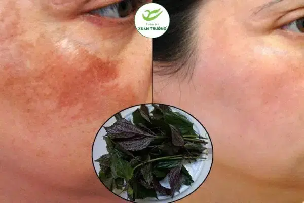 cach tri nam bang la tia to 3 Lá tía tô tươi giúp hỗ trợ làm sáng da, mờ nám tự nhiên