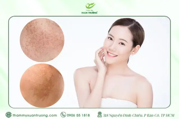 Hướng Dẫn Chăm Sóc Da Bị Nám Khoa Học, An Toàn Và Hiệu Quả