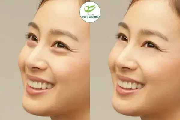 Bọng mắt dưới mí dưới khiến gương mặt kém tươi tắn