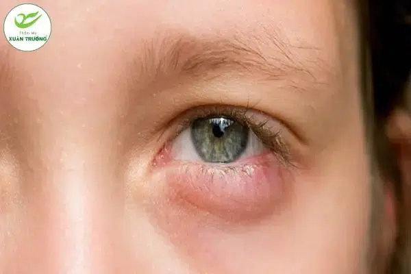 Bọng mắt sưng to có thể liên quan bệnh lý tiềm ẩn