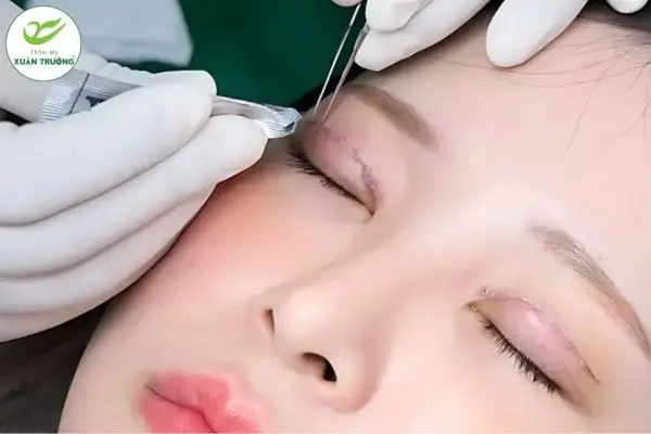 Không để nước tiếp xúc trực tiếp vùng mí 3–5 ngày đầu